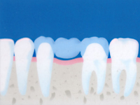 インプラントブリッジは、抜けてしまった歯の両隣にある歯を削り、義歯を取りつける方法です。。