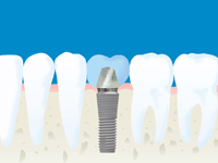 なぜインプラント治療なのか